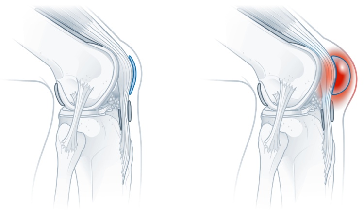 All You Need to Know About Bursitis All You Need to Know About Bursitis