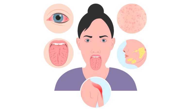 Causes Of Sjogrens Disease Causes Of Sjogrens Disease