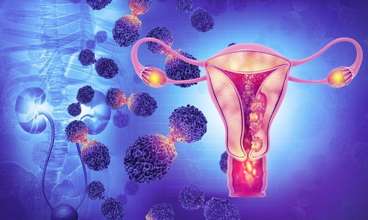 Cervical cancer cost in india Cervical cancer cost in india