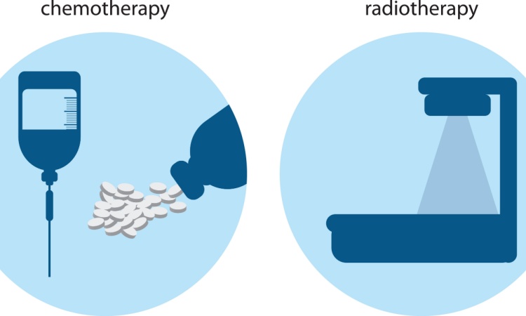 Radiotherapy And Chemotherapy Radiotherapy And Chemotherapy