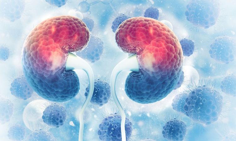 Kidney cancer cost in india Kidney cancer cost in india