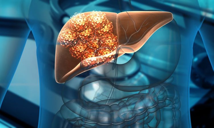 Liver cancer treatment cost in india Liver cancer treatment cost in india
