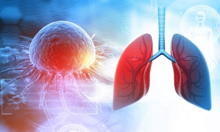 Lung cancer treatment in india cost Lung cancer treatment in india cost