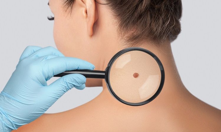 Skin Cancer Awareness - HDFC ERGO Blogs Skin Cancer Awareness