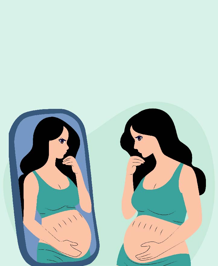 Does Weight Loss Cause Stretch Marks?