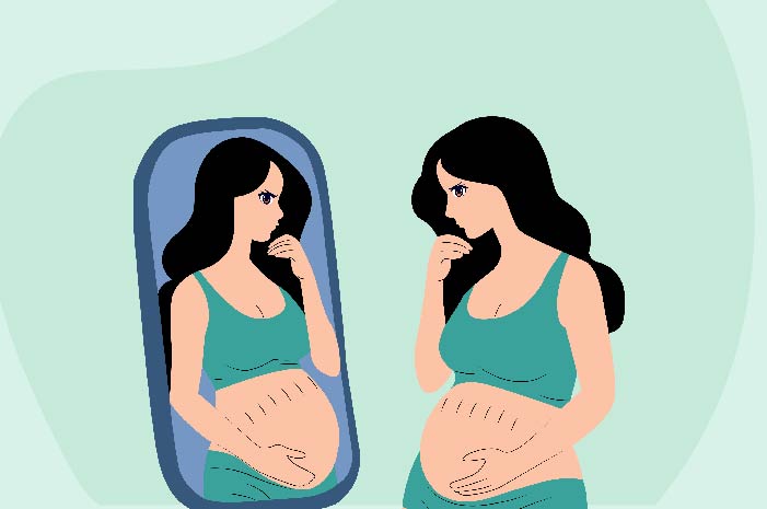 Understanding the Link Between Weight Loss and Stretch Marks