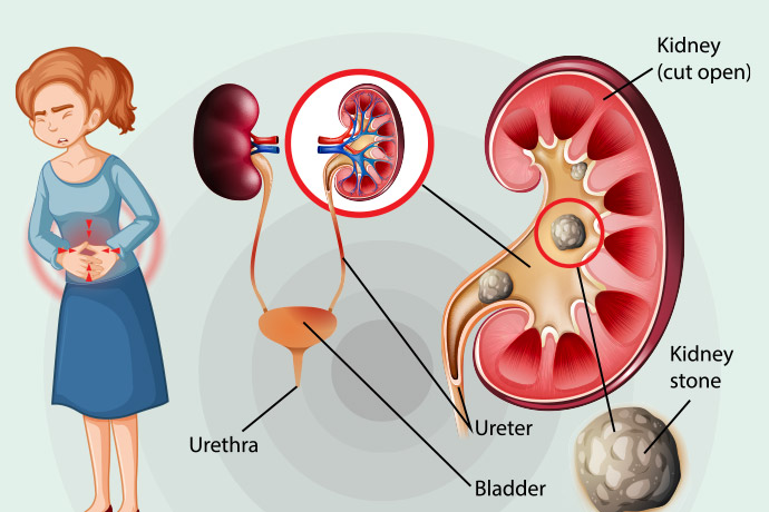 Kidney Stones – All You Need To Know