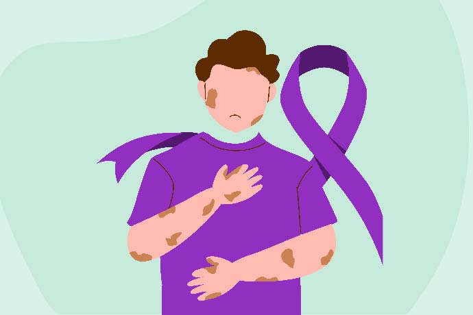 Leprosy - Diagnosis, treatment, and prevention