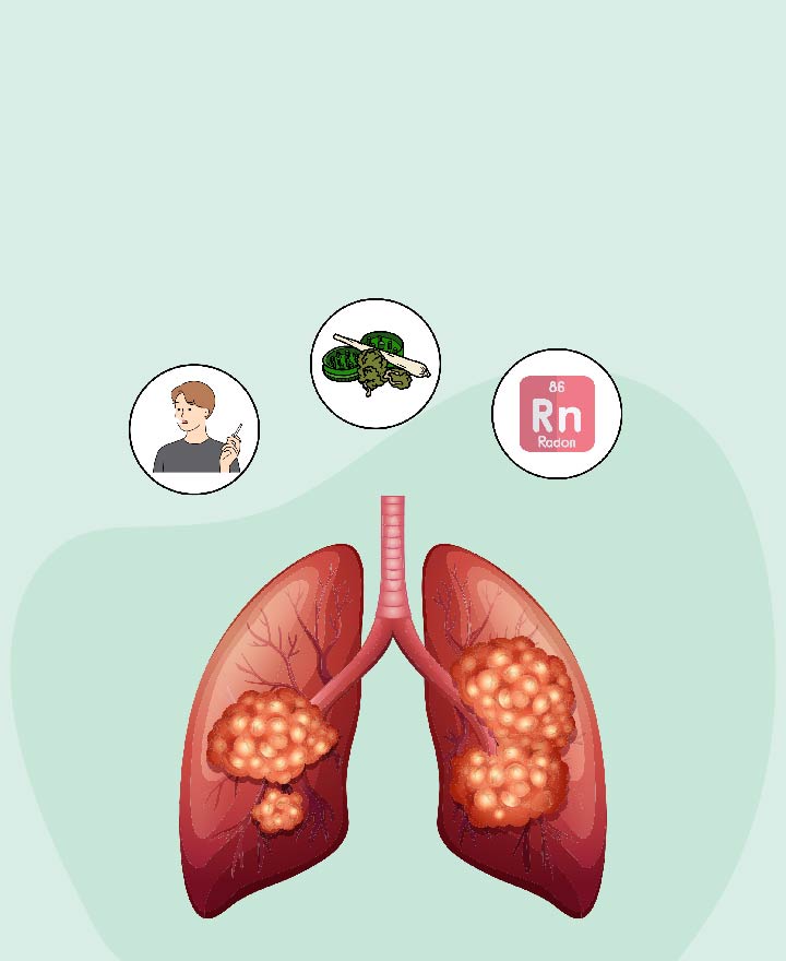 What causes Lung Cancer?