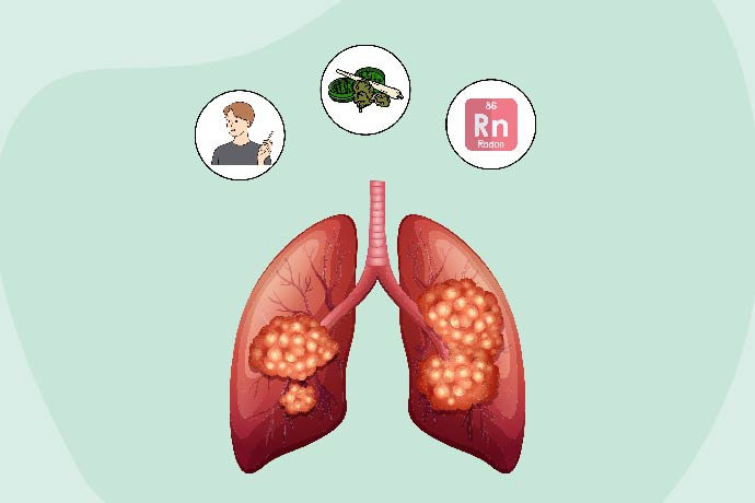 Understanding Lung Cancer Causes 