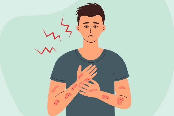 Psoriasis - symptoms and causes 