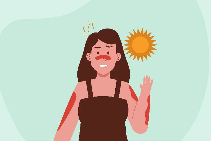 How to treat Sunburn: 10 home remedies for instant relief