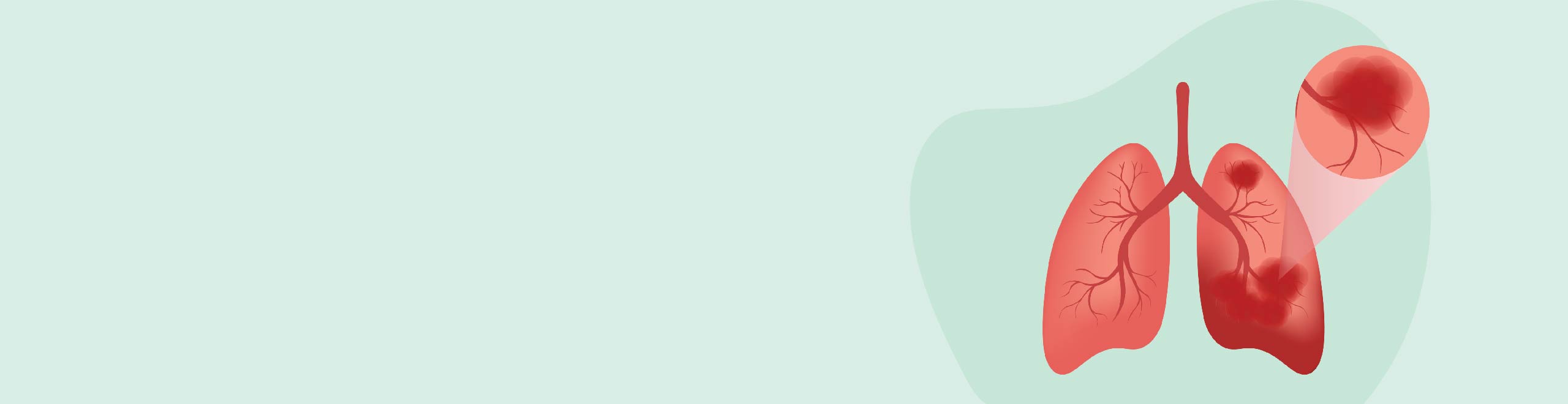  Types of Lung Cancer