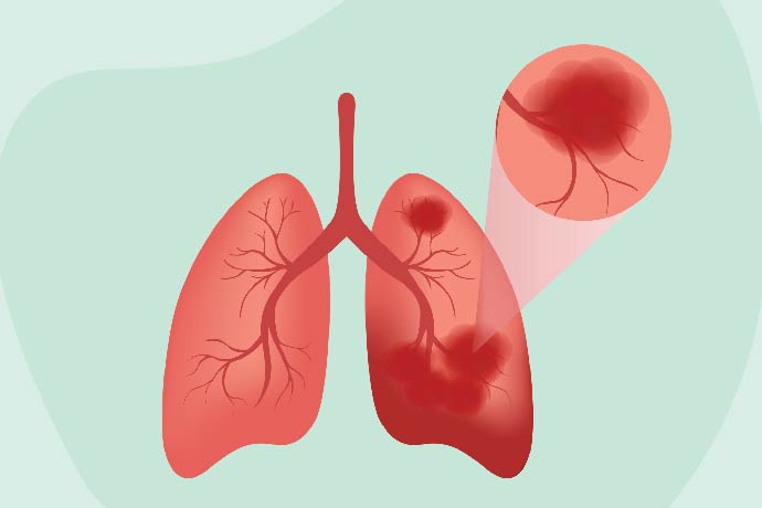 Types of Lung Cancer: Common, Rare & More 